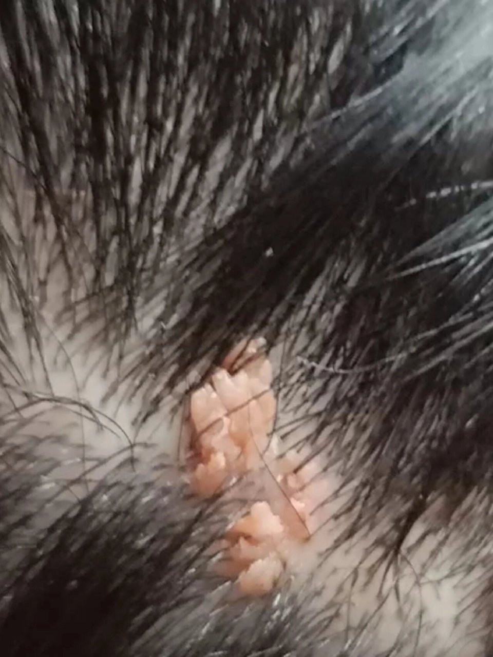 头皮长疣,看过医生说是疣让激光 这个是会自体传播吗?
