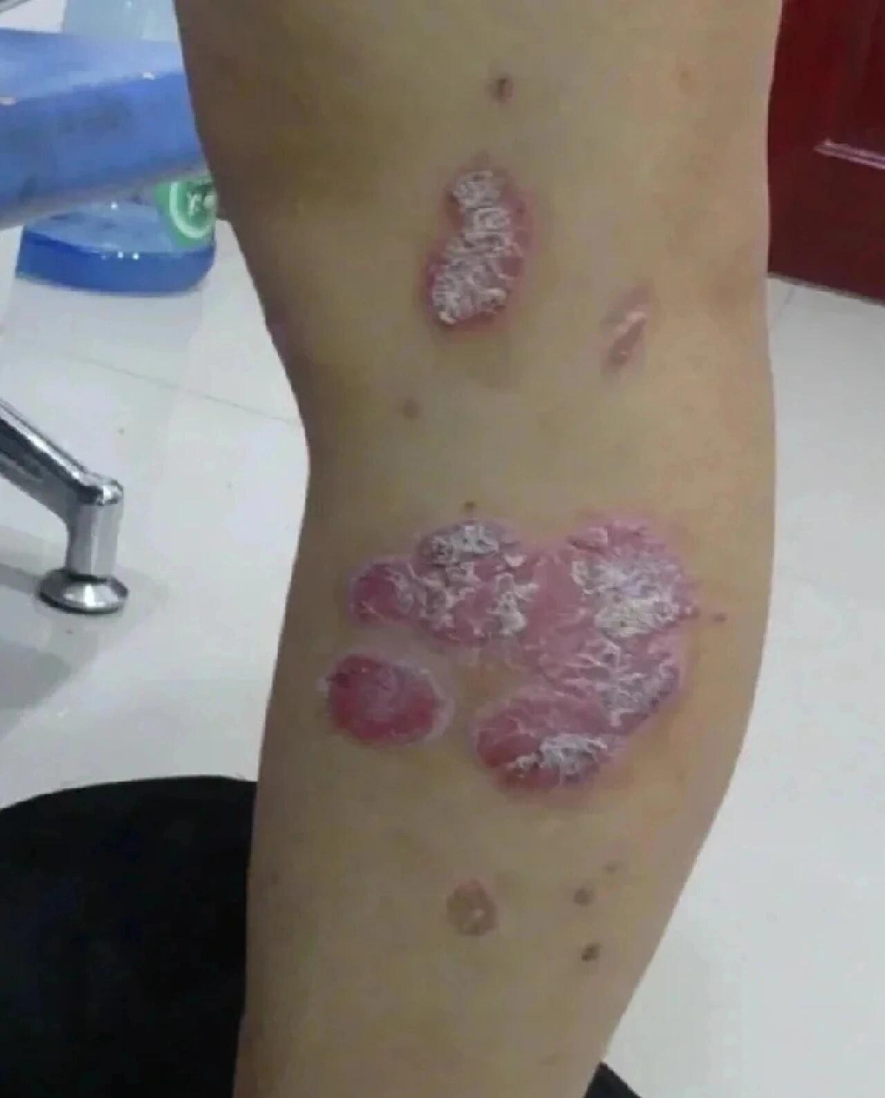 腿上牛皮癣好了,.终于和解了