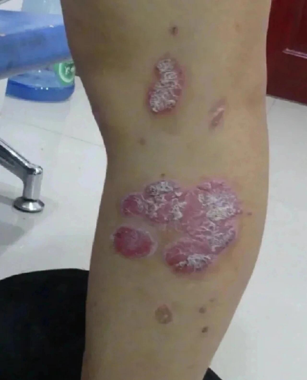 腿上牛皮癣好了,.终于和解了 在这一刻