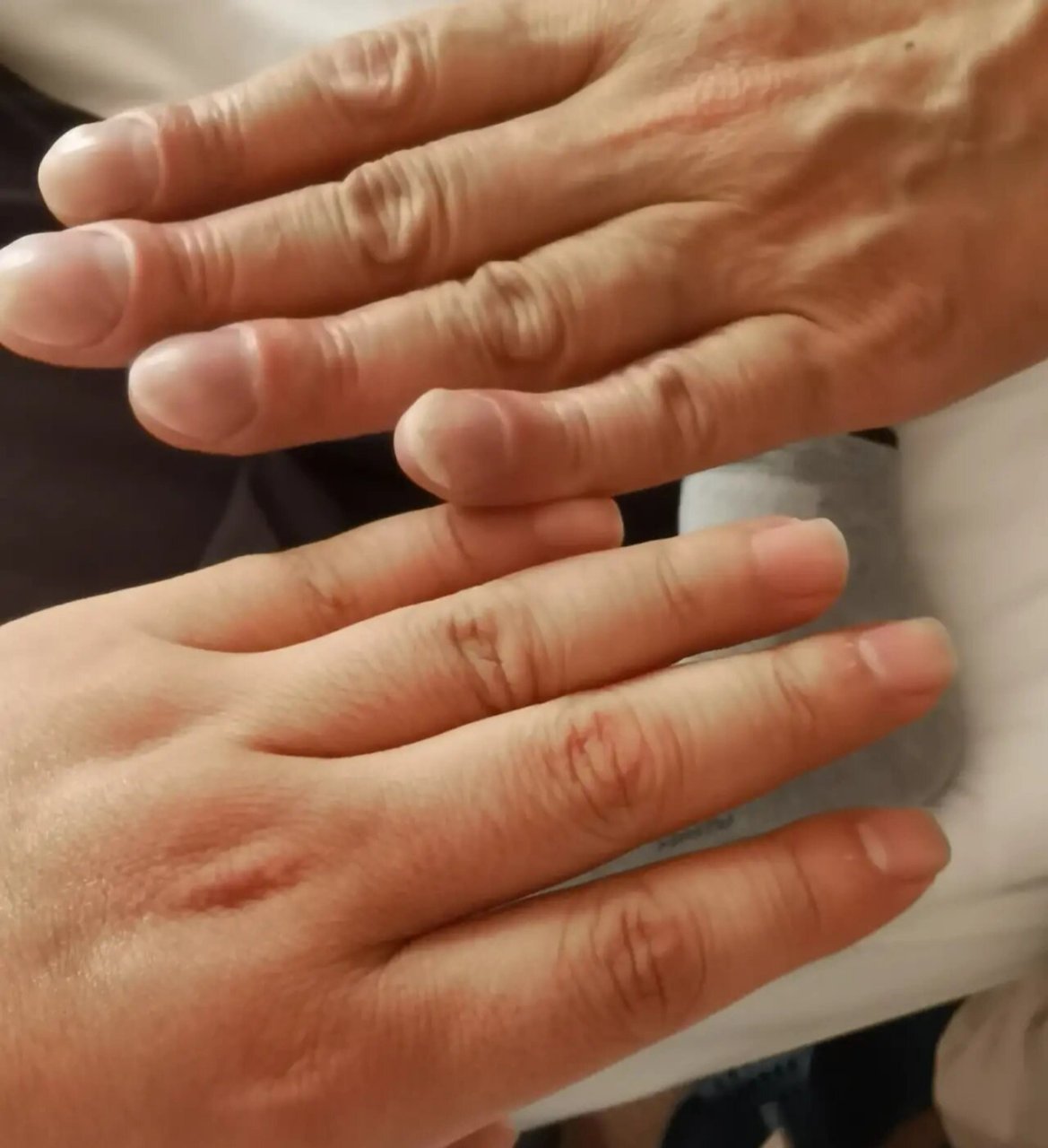 有杵状指就是肺癌吗?