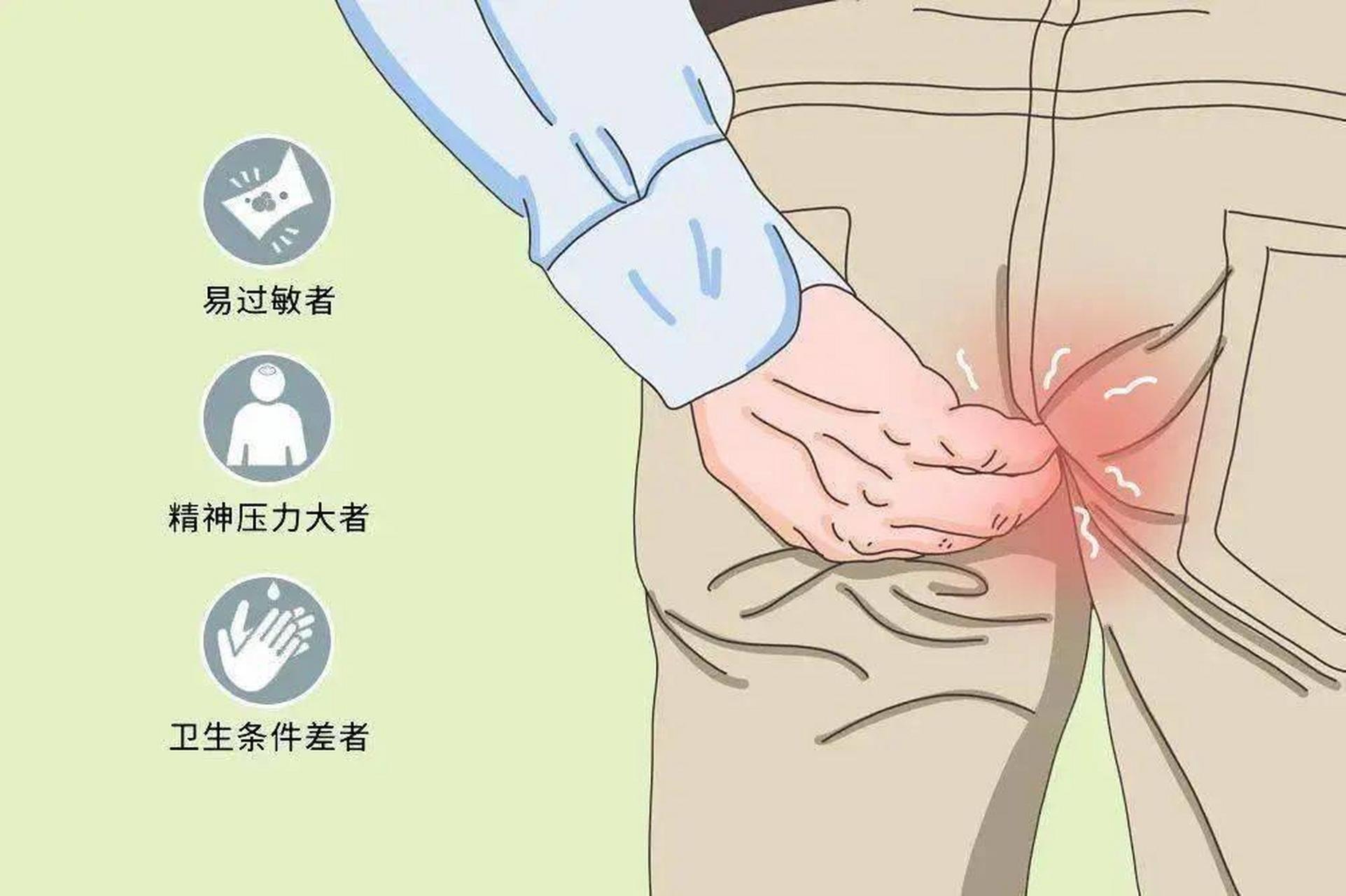 【比肛门疼还难受的是肛门痒】 患者泪眼婆娑来到诊室,一问才知道是