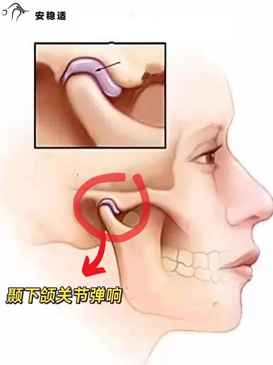 颞颌关节磨损图片