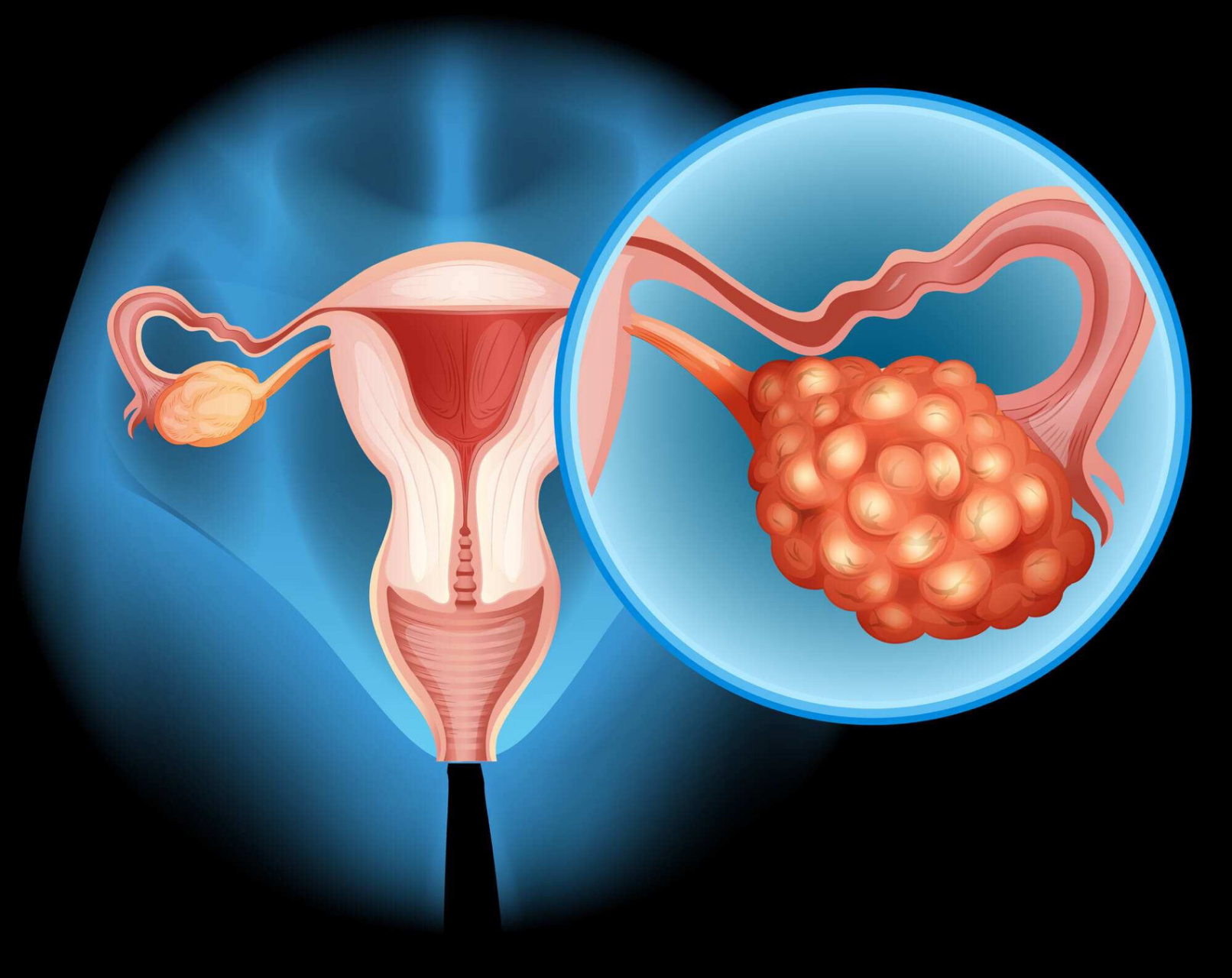 多囊卵巢综合征需要长期用药控制,停药后症状复发,不能治愈