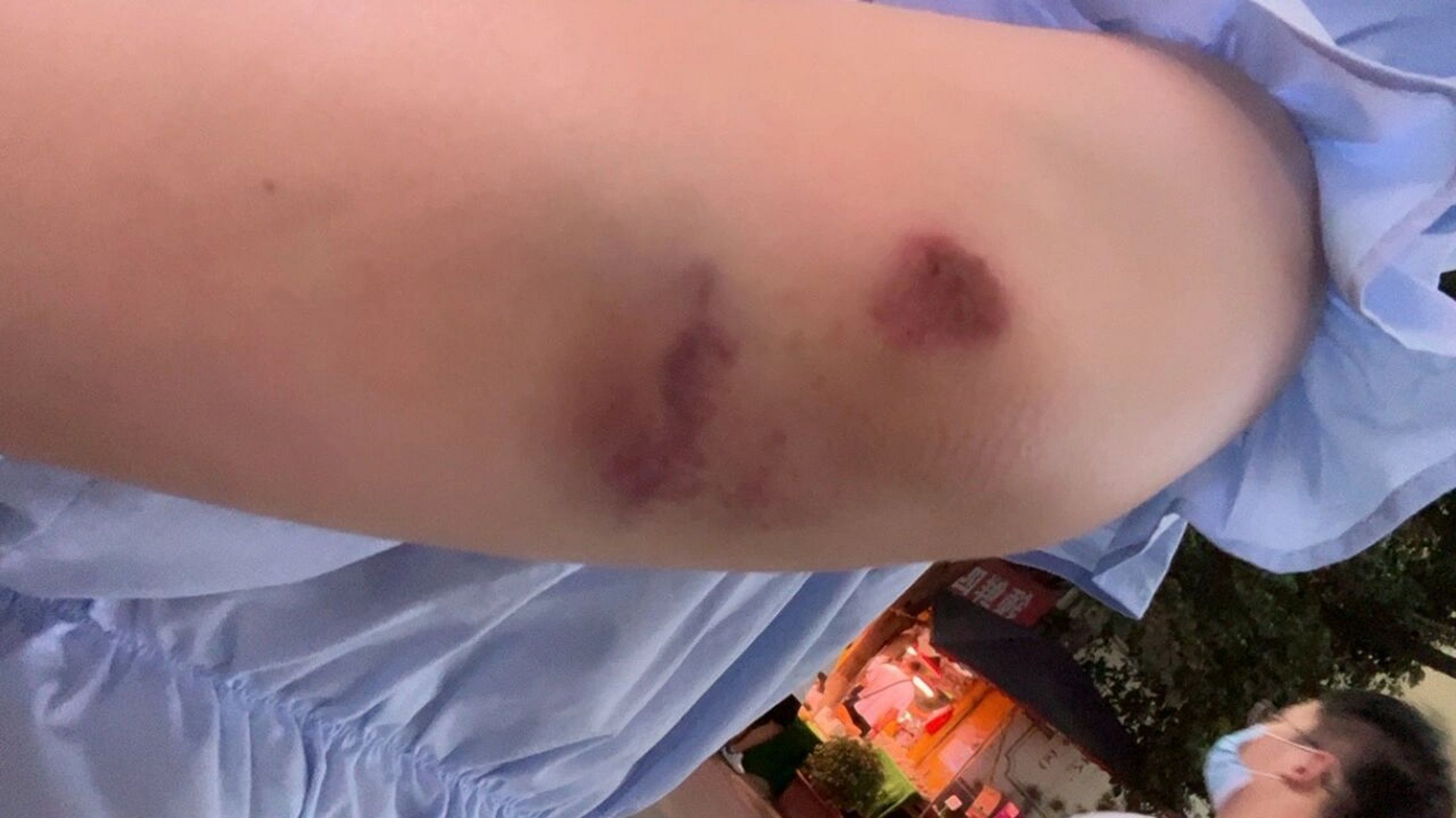 骑车摔的胳膊肘淤青 摔的够惨的,旁边人还多,又疼又尴尬