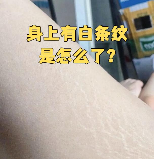 身上有白条纹是怎么了?