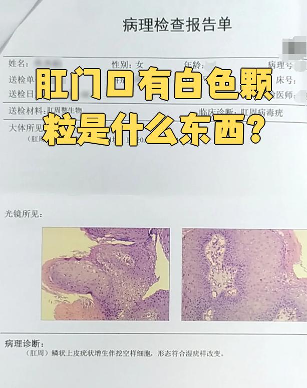 肛门口出现白色颗粒可能是肛周炎,肛周疱疹或肛周湿疣引起的