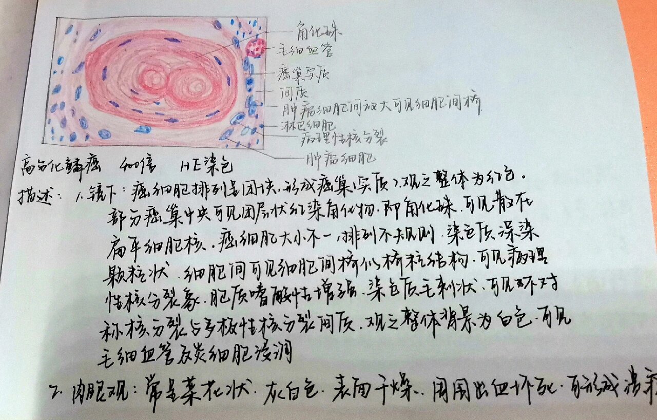 高分化鳞癌 高分化鳞癌病理学铅笔手绘