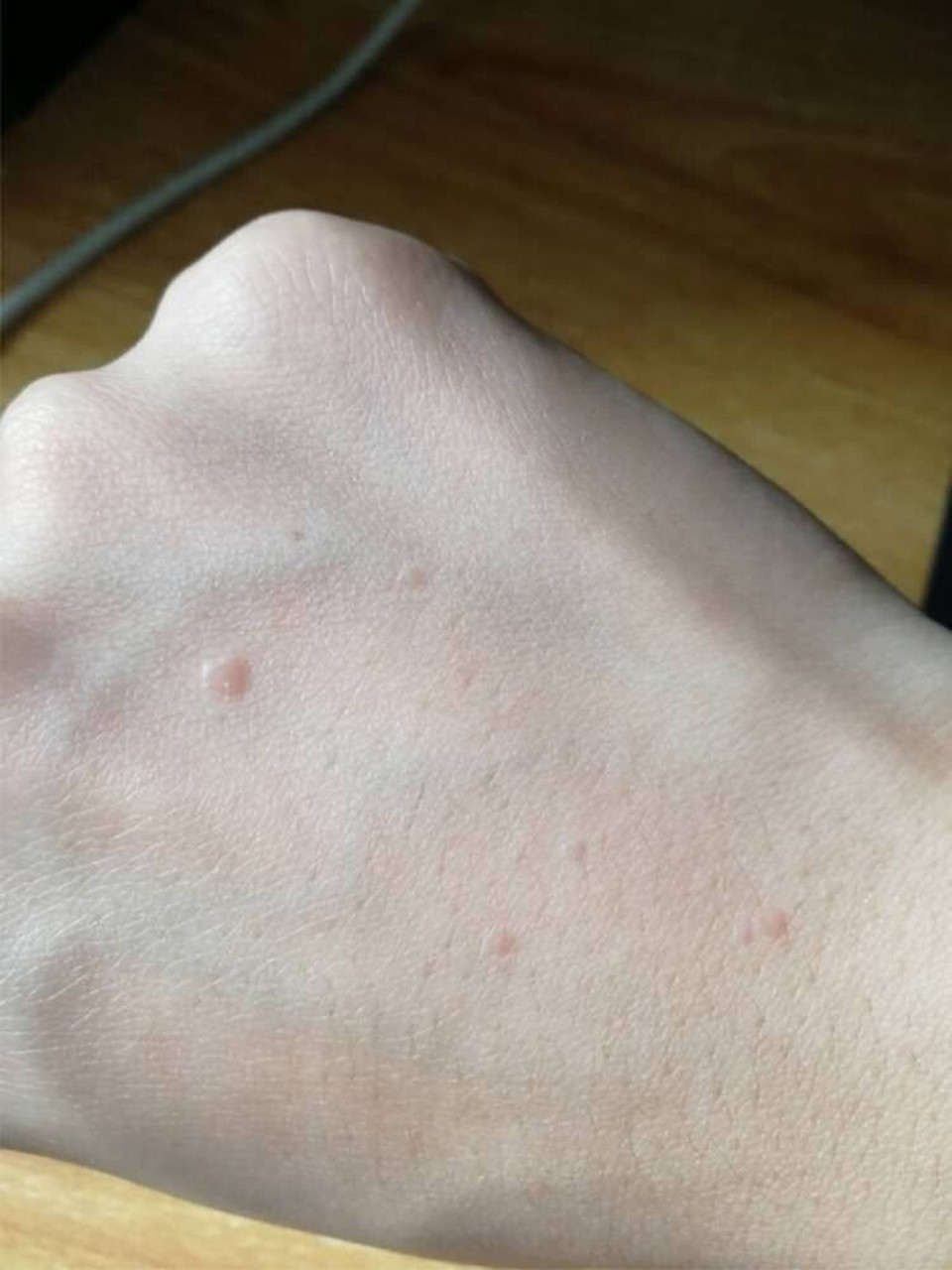 也没什么其他大的影响 9797扁平疣是一种由病毒引起的皮肤病