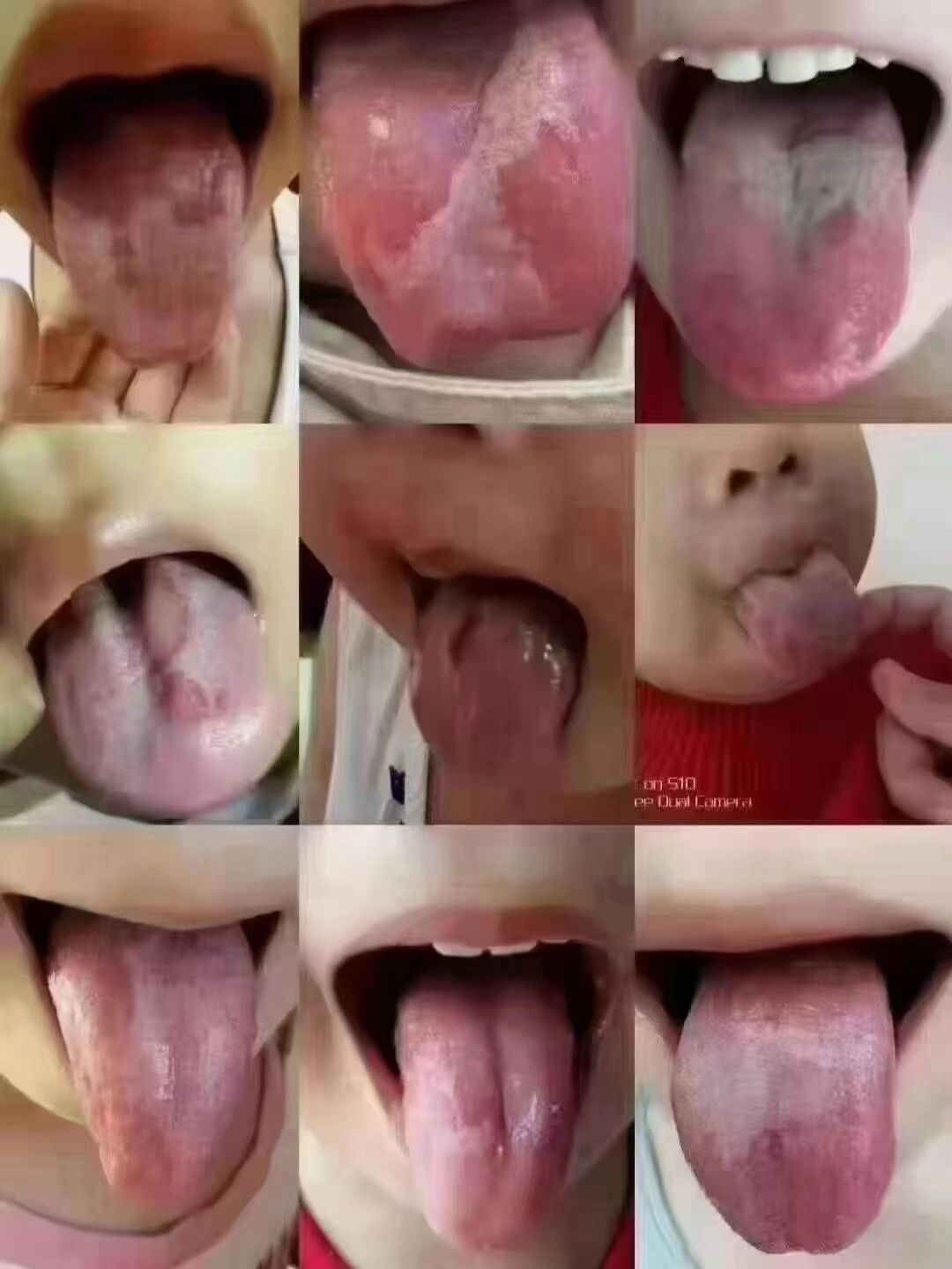 地图舌,裂纹舌,花剥舌到底代表什么 92 地图舌 裂纹舌 花剥苔,代