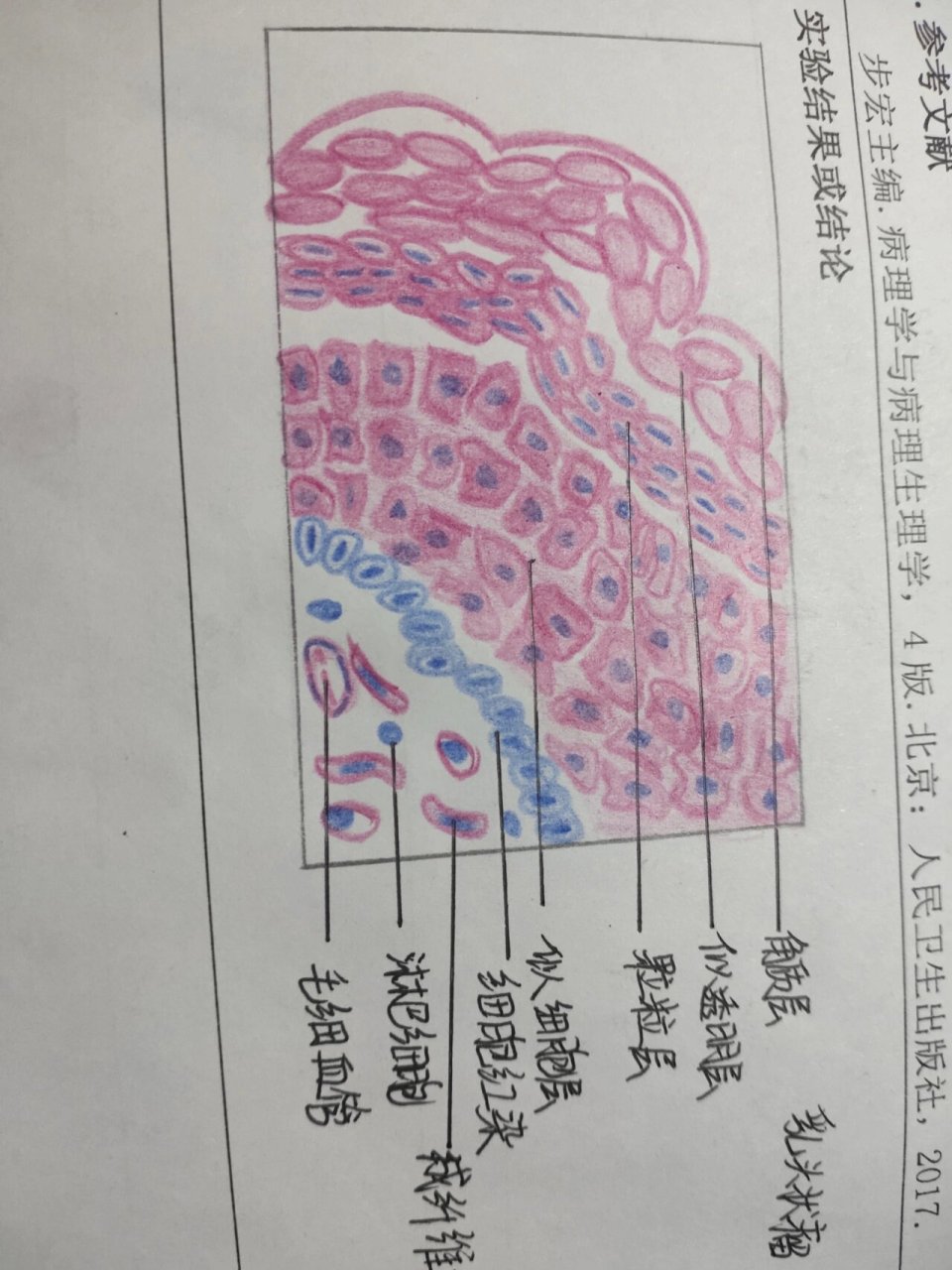 动脉粥样硬化切片图解图片