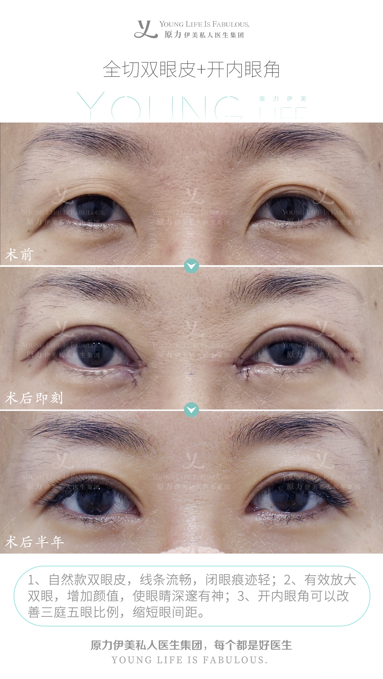 一招 让眼睛轮廓更精致 #原力伊美私人医生集团#全切重睑术#微创双眼