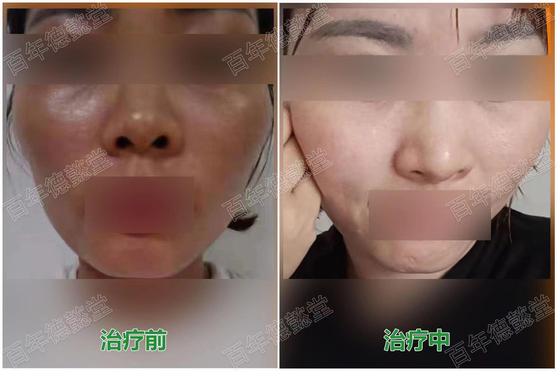 西医治疗皮肤黑变病主要是使用大剂量维生素c维生素e及激光等方法治疗