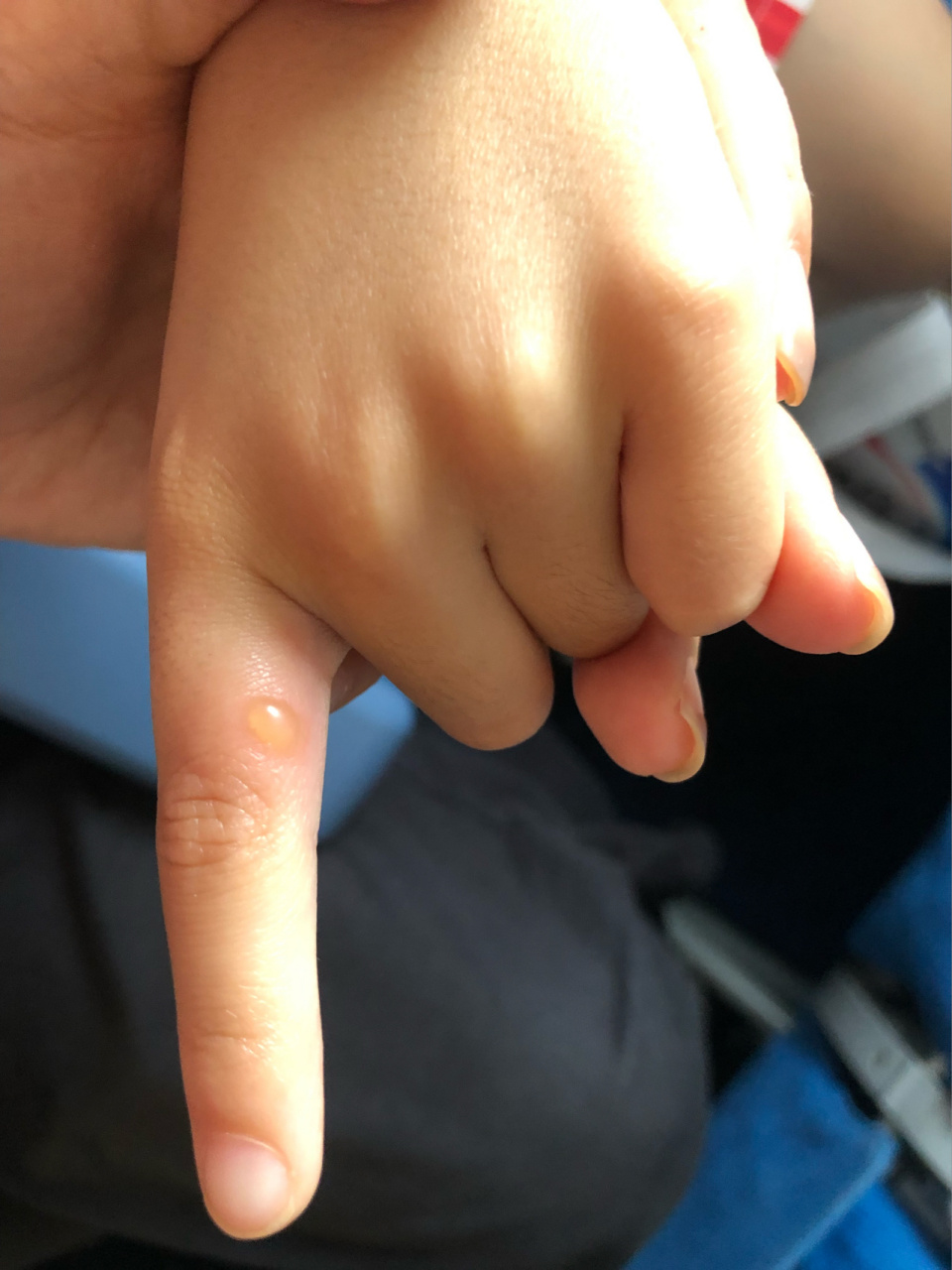 孩子被什么虫子咬了 早起发现孩子手起了个大水泡,不知道什么咬的