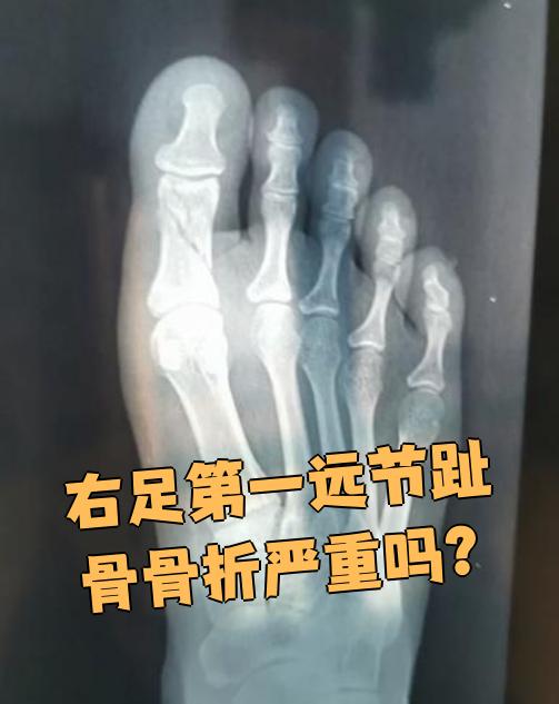 右足第一远节趾骨骨折的严重程度要看具体情况