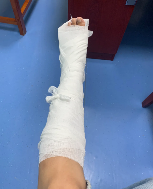 骨头愈合需要多久?