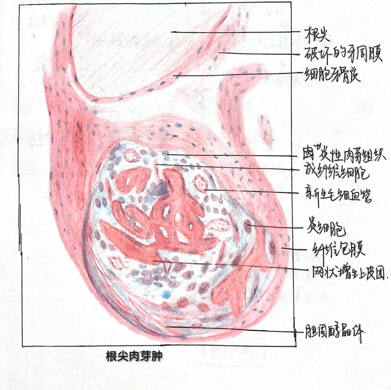 首页 82p2:钟状期成釉器 82p3:牙体组织 82p4:根尖肉芽肿 82