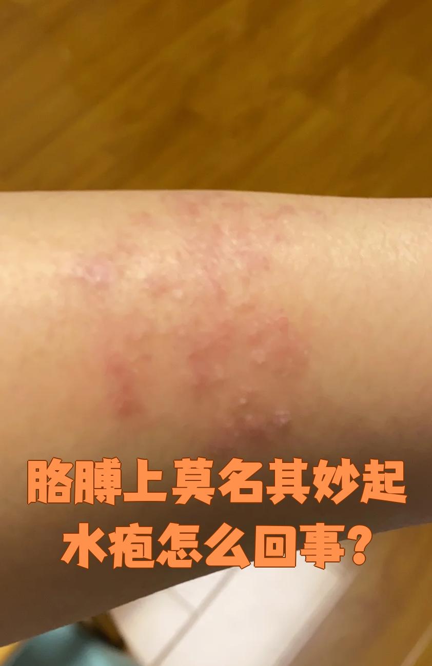 常见的情况包括摩擦,接触性皮炎,水痘,湿疹,汗疱疹,带状疱疹,丘疹性荨