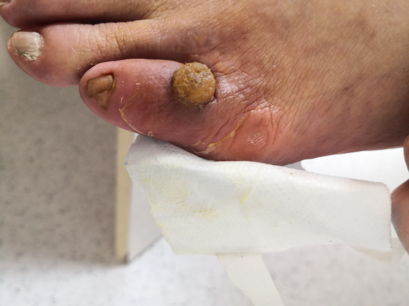 考虑寻常疣或者化脓性肉芽肿症状.