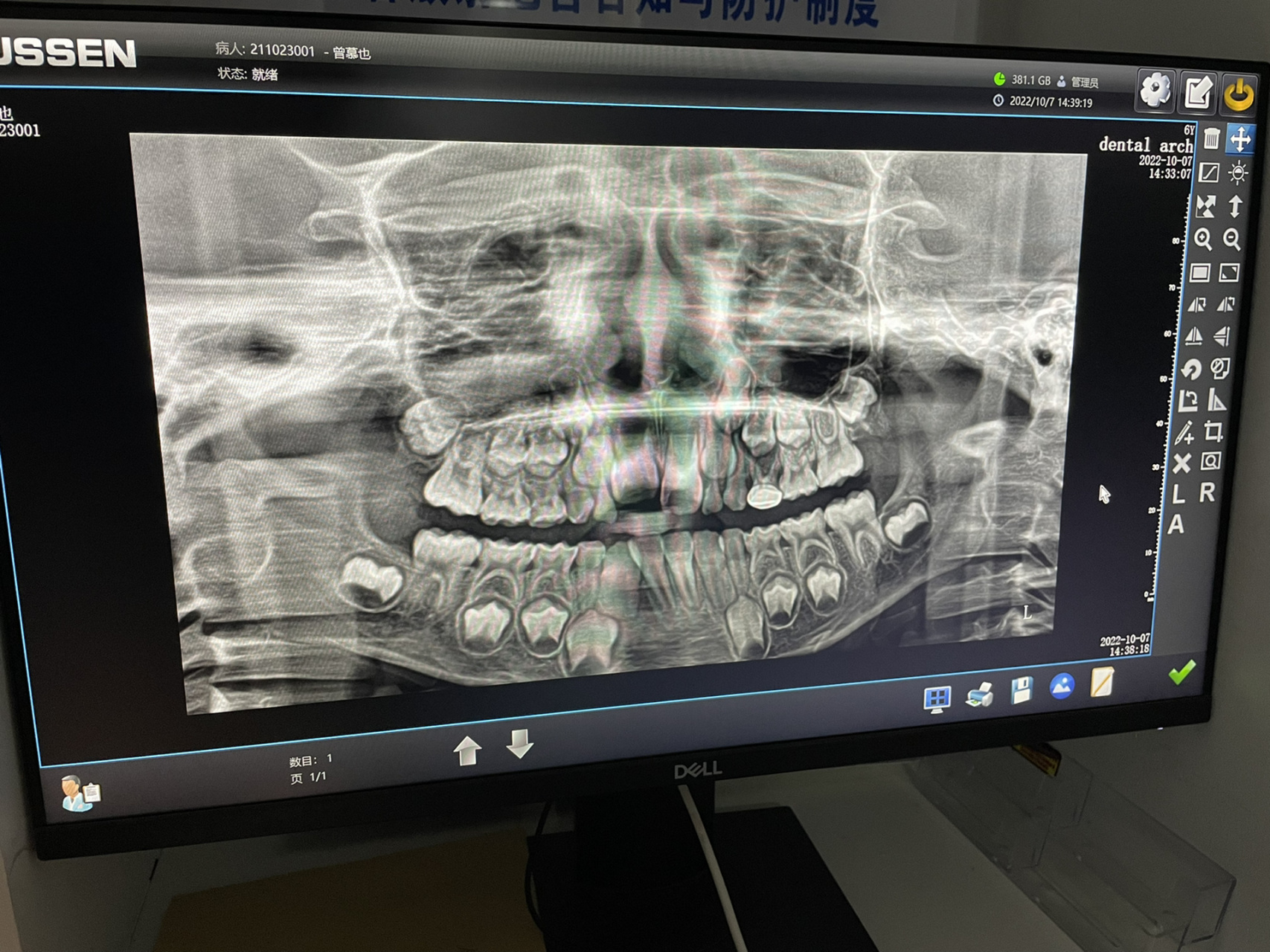 8岁儿童扩弓矫正 图一:牙片 有腺样体肥大,张口呼吸情况,6岁已手术