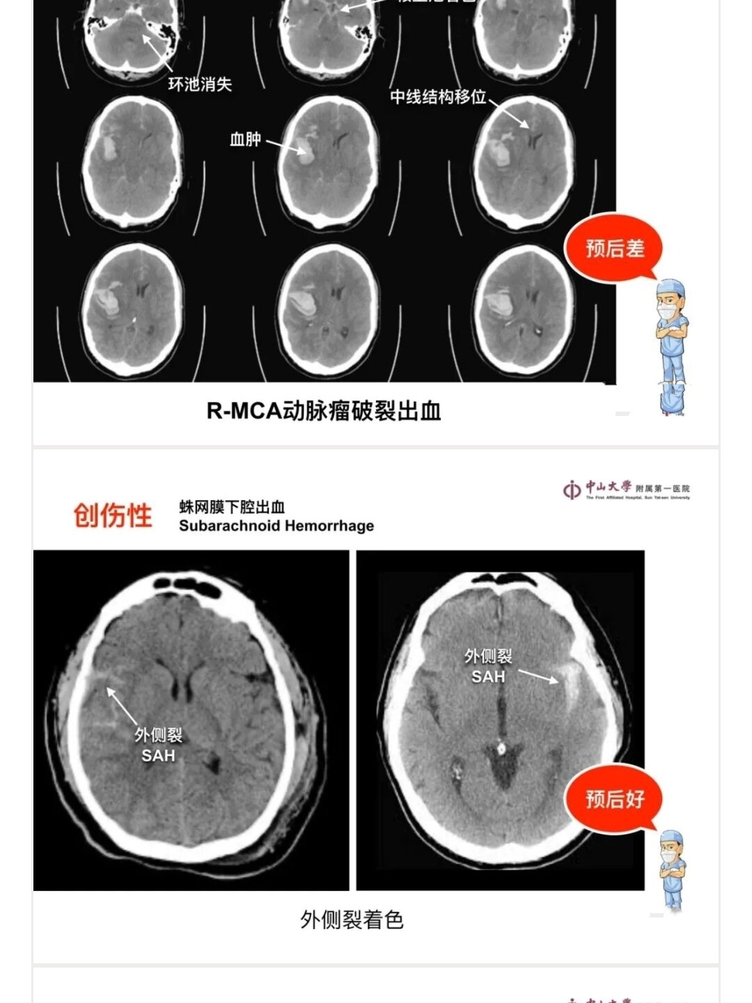 脑梗死的CT图片