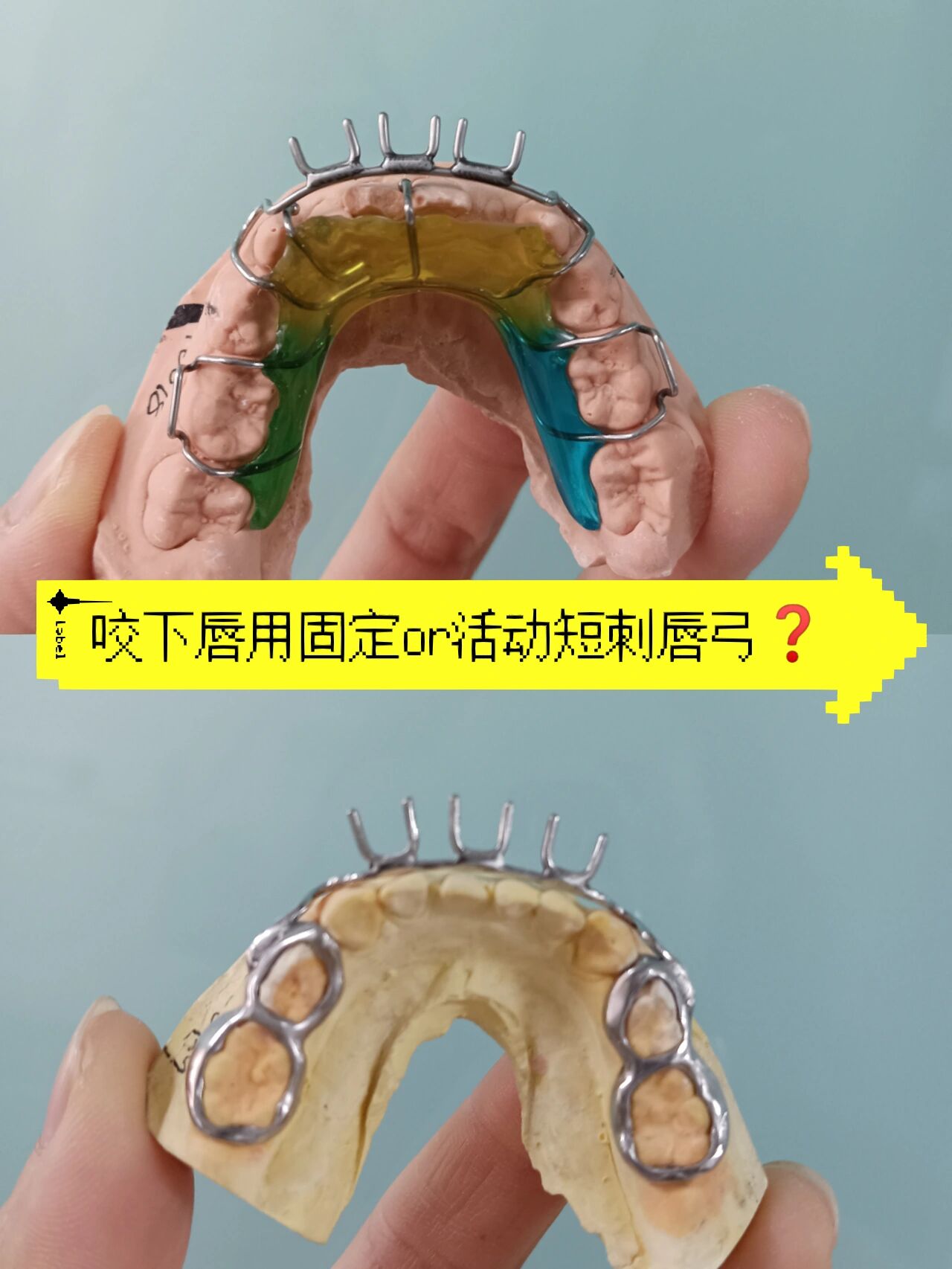 两款矫治器都是矫正患者咬下唇的不良习惯 最大的区别是  一个固定在