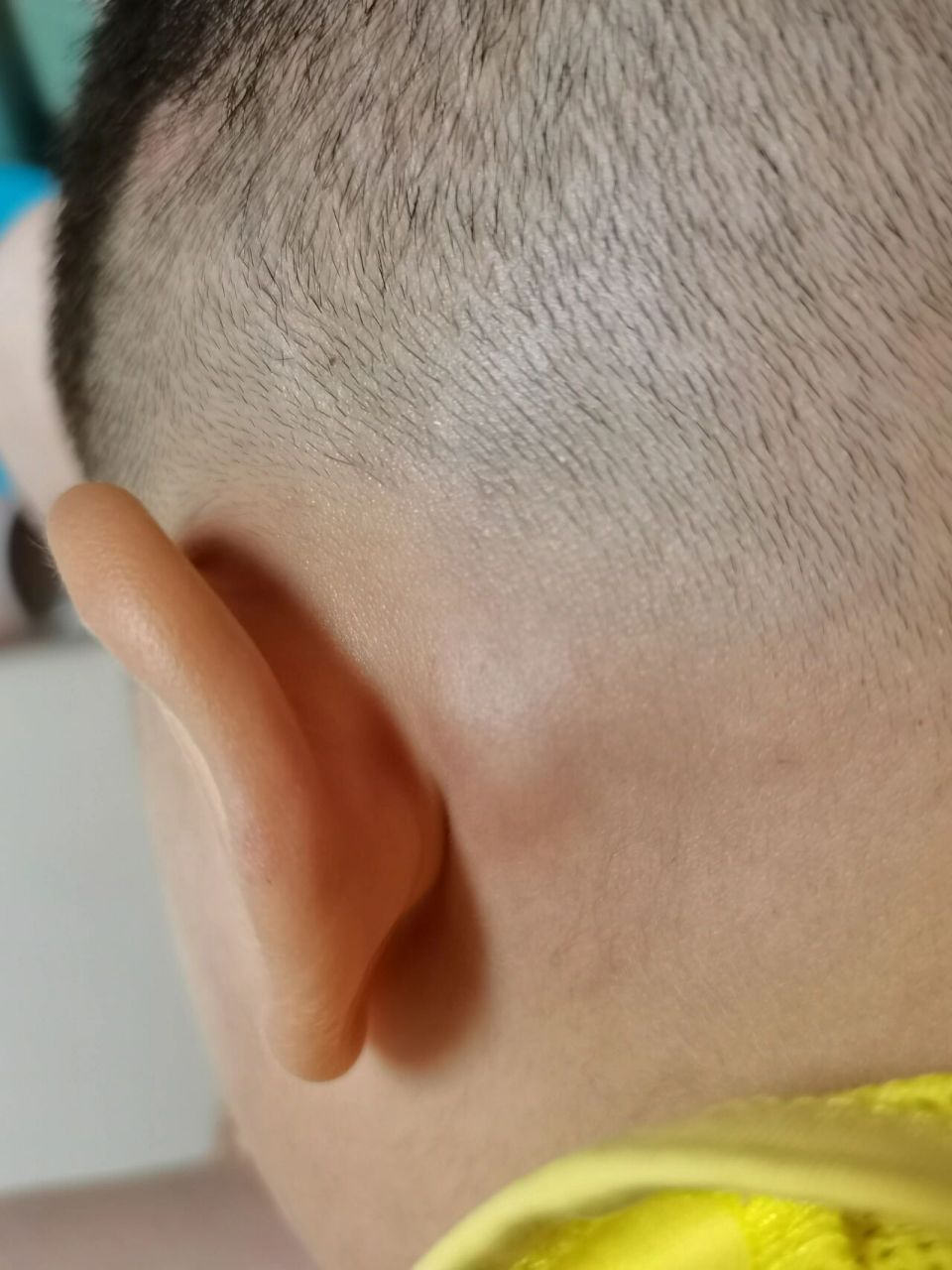 耳后有个包 孩子耳朵后面有个包,一两岁的时候只有绿豆大,现在四岁有