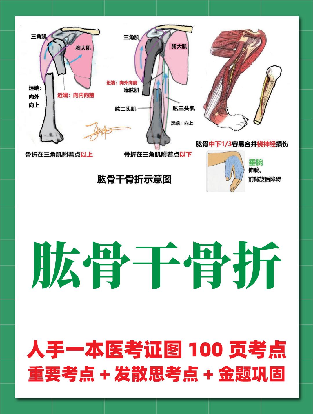24临床执医|医学生笔记99肱骨干骨折 24临床执业医师考点《肱骨干