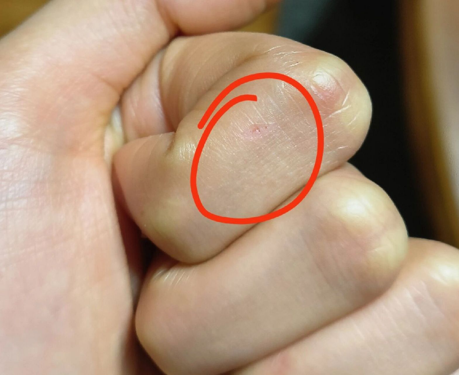 今天想摸小狗的头,她突然咬我一口,有图片这样的伤口,要不要打狂犬