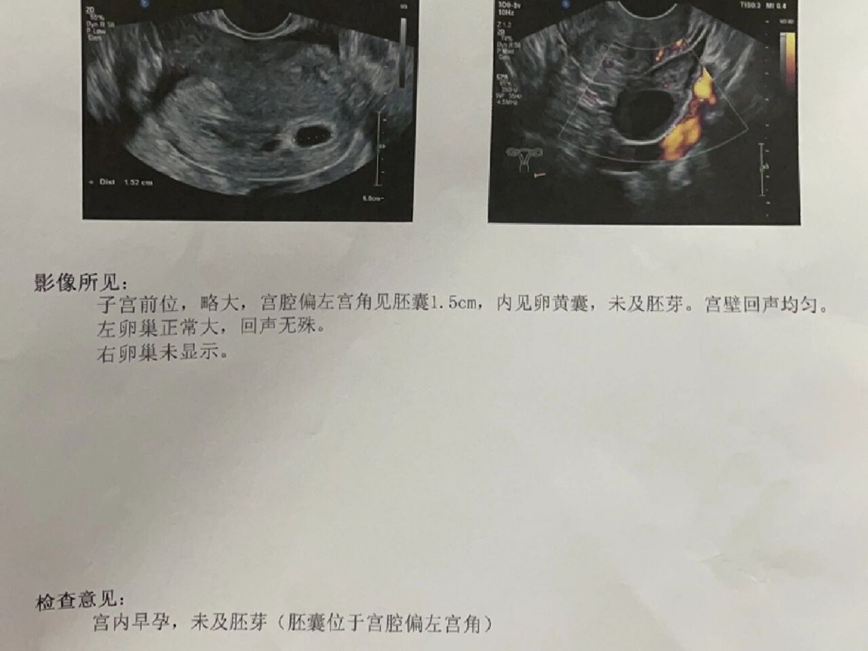 07 无胎心胎芽 偏左宫角妊娠 已经过去两周了 孕50天 还有机会回正吗