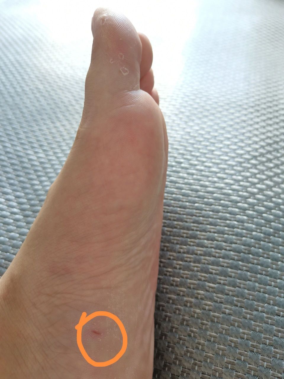 产后六个多月脚底倒刺 早晨以为脚扎刺儿了,就没看随手拔了.然后.