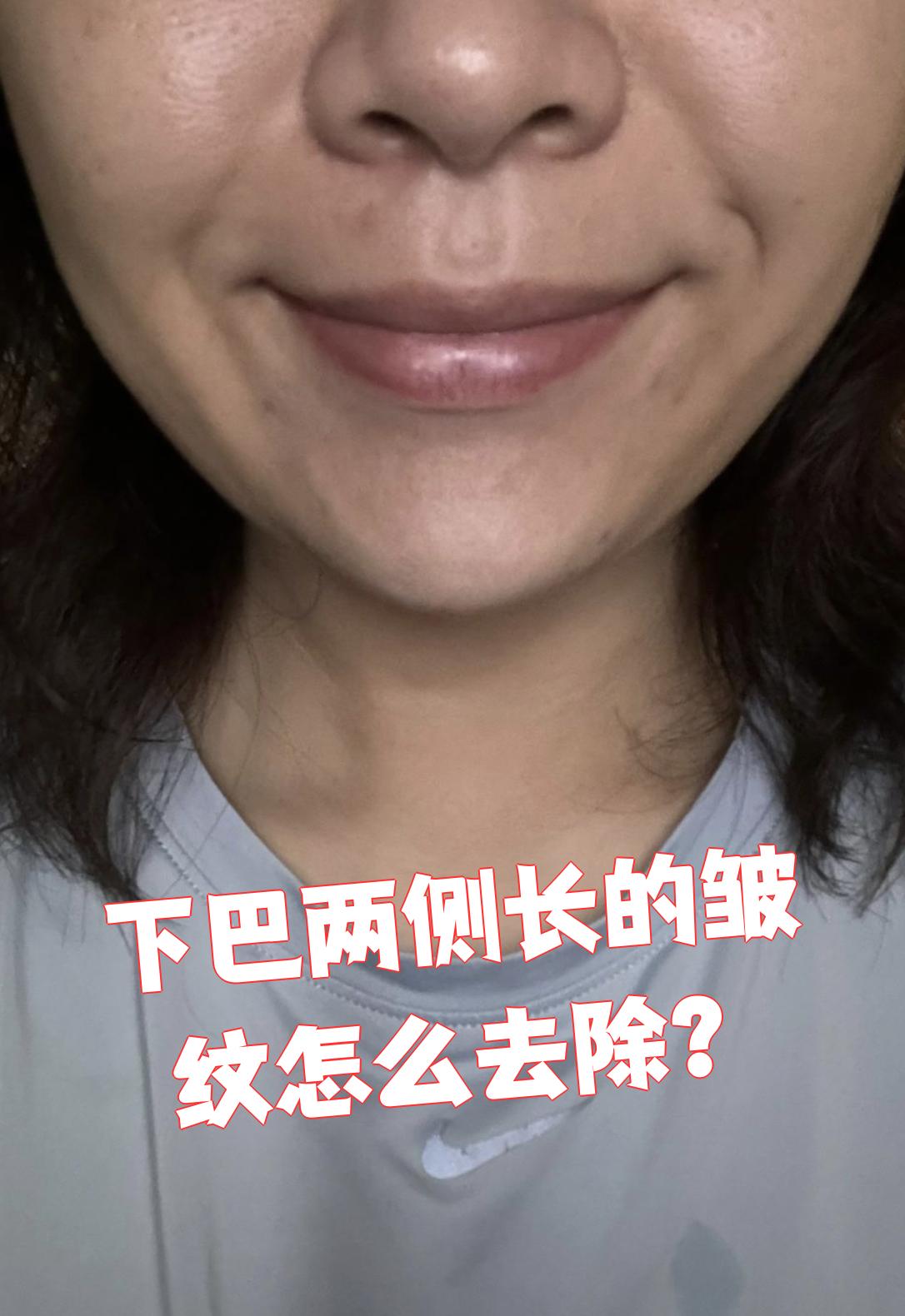下巴两侧的皱纹可以通过玻尿酸注射线雕热拉提或者按摩来改善