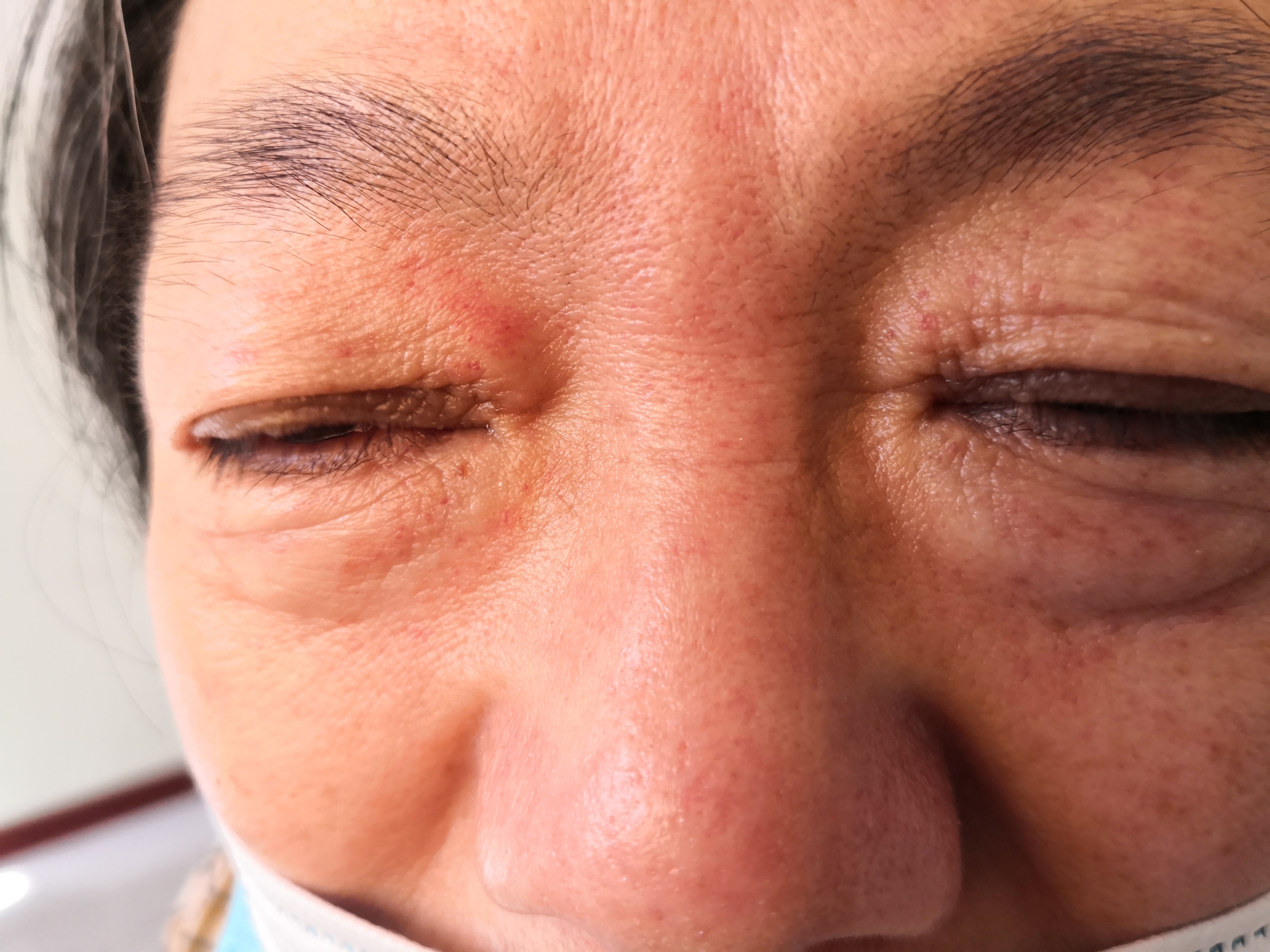 眶周针尖大小暗红色红斑.考虑压力性紫癜症状