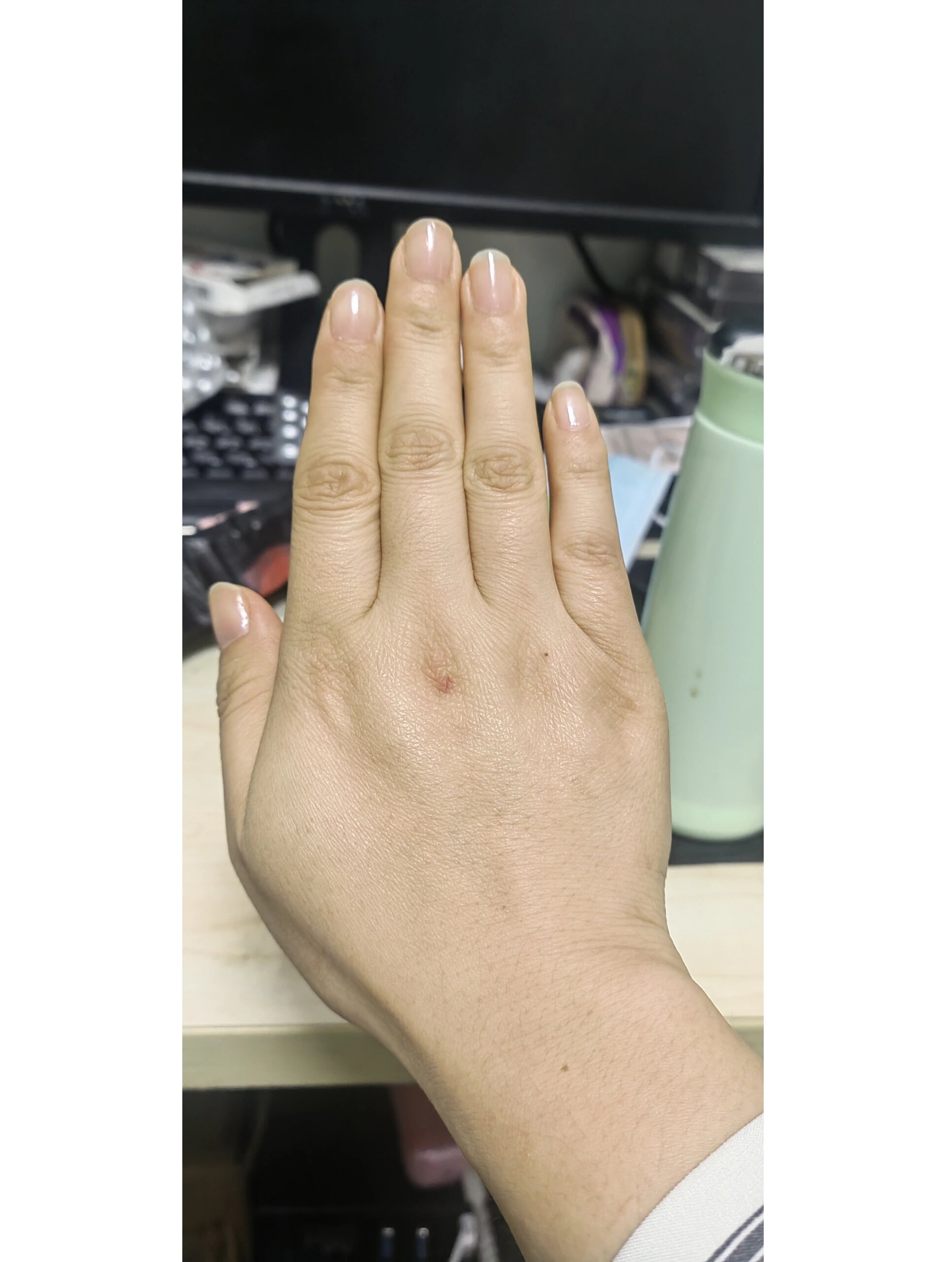 手背突然出现紫红色斑块