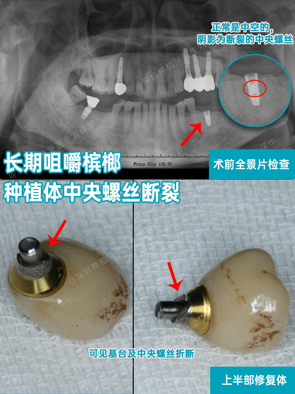 长期咀嚼槟榔种植体中央螺丝折断深圳种植牙深圳种牙