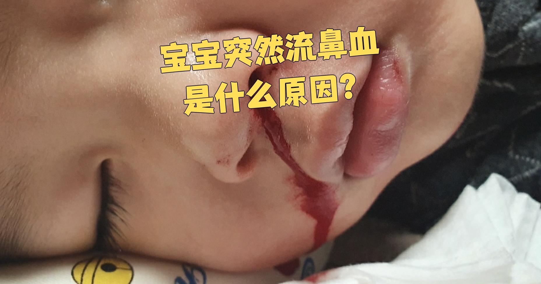 宝宝突然流鼻血可能和这些原因有关:空气太干,鼻子受伤,或者血小板