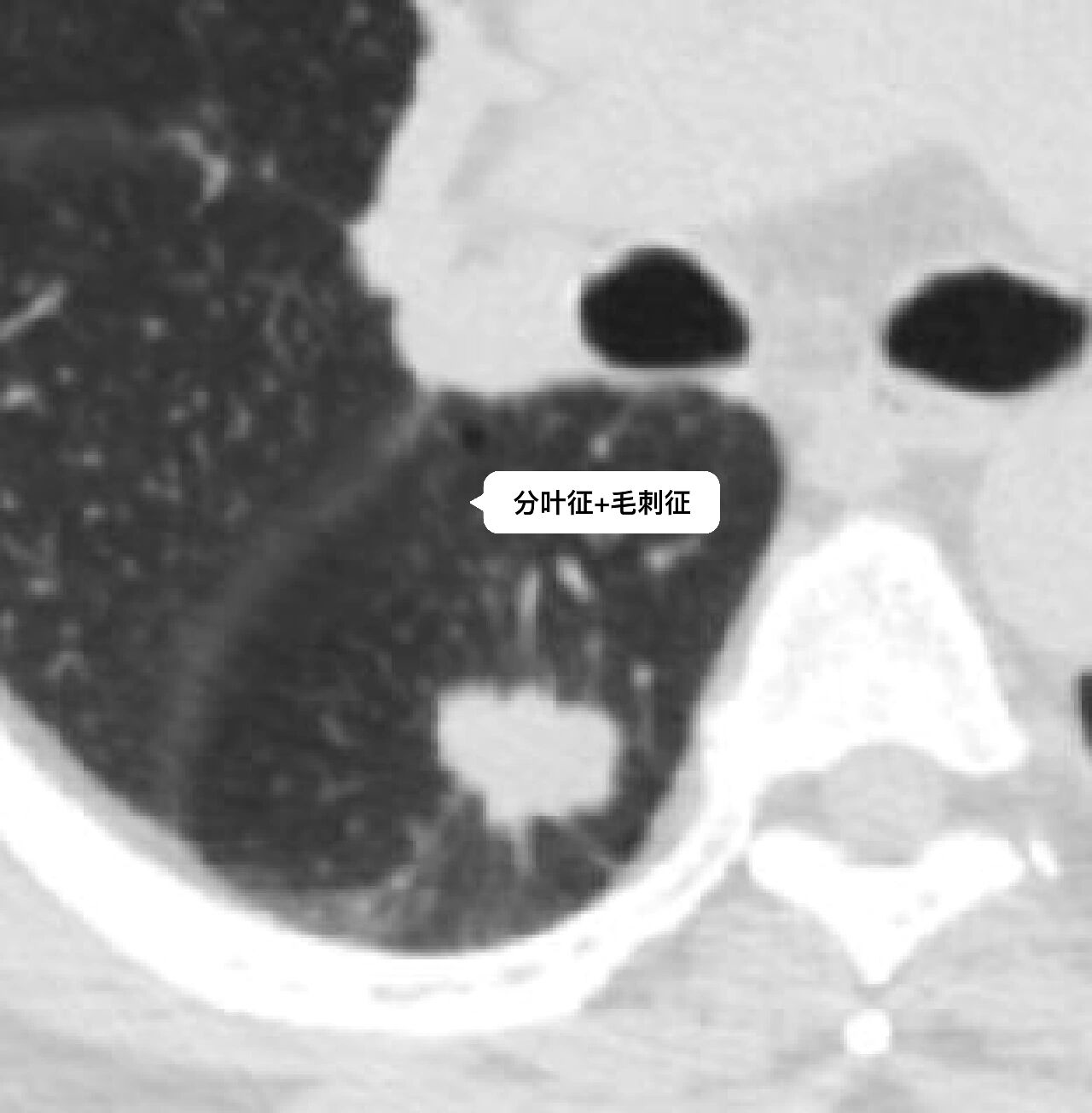 周围型肺腺癌典型影像学征象(一) 肺腺癌典型征象分叶征,毛刺征,支