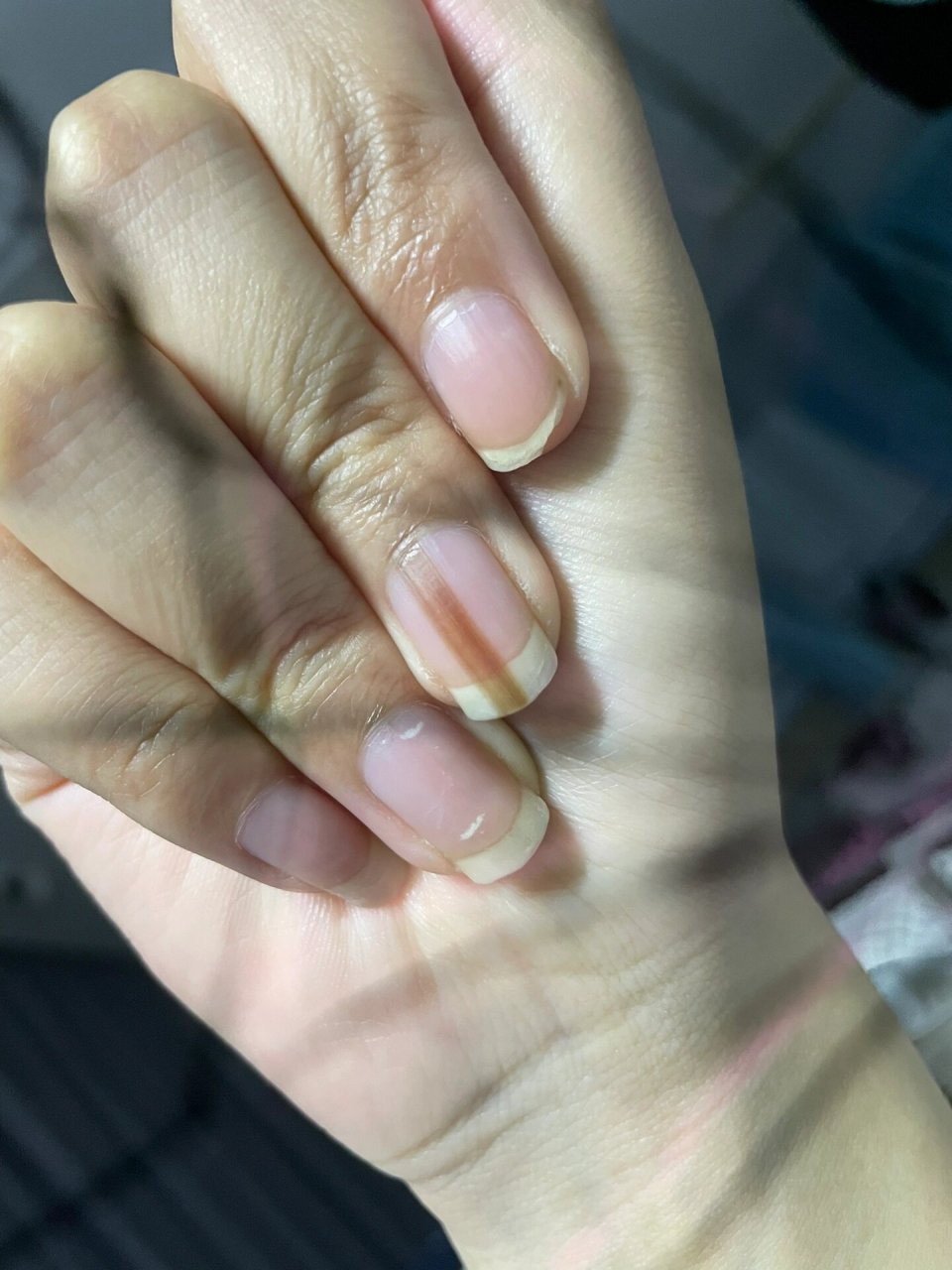 初中突然就发现了这个还以为是不小心弄到了结果没想到是甲母痣.