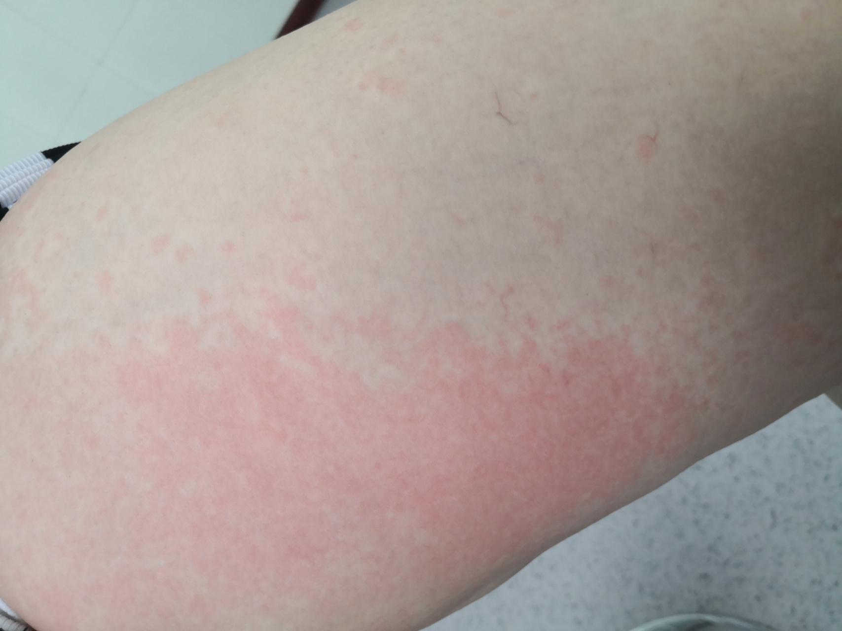 全身泛发红斑风团症状.考虑荨麻疹症状#过敏##荨麻疹