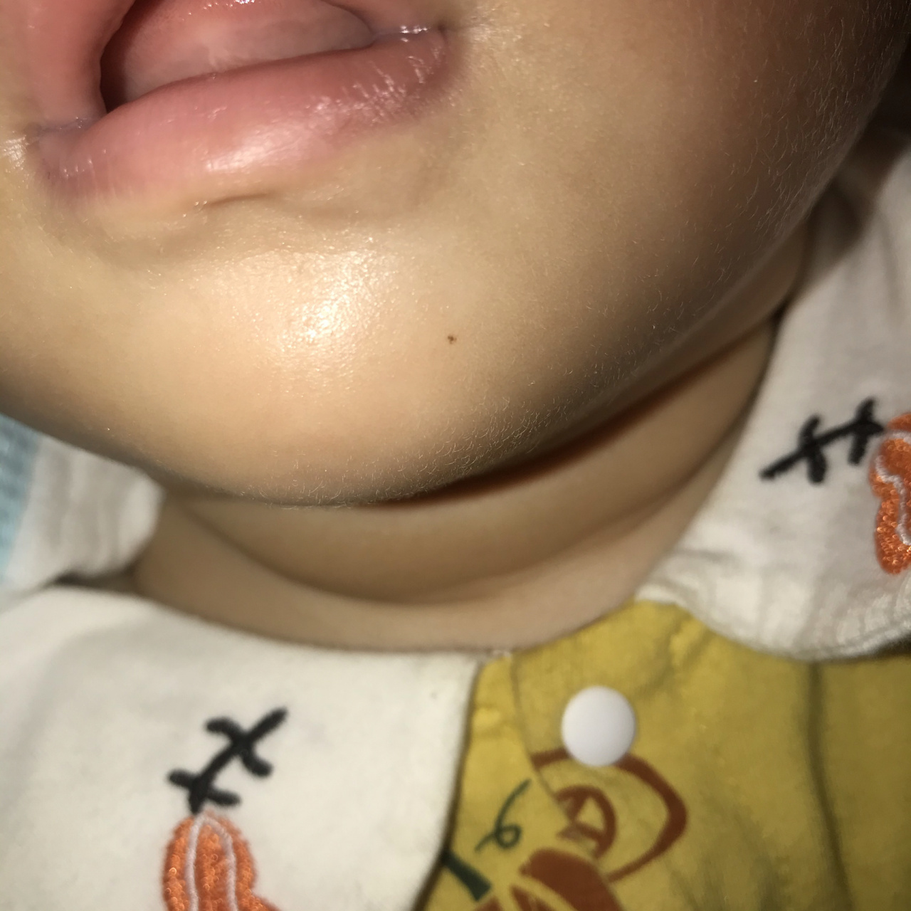 宝宝脸上长了颗痣,而且越来越大 宝宝出生到现在我一直都没发现她身上