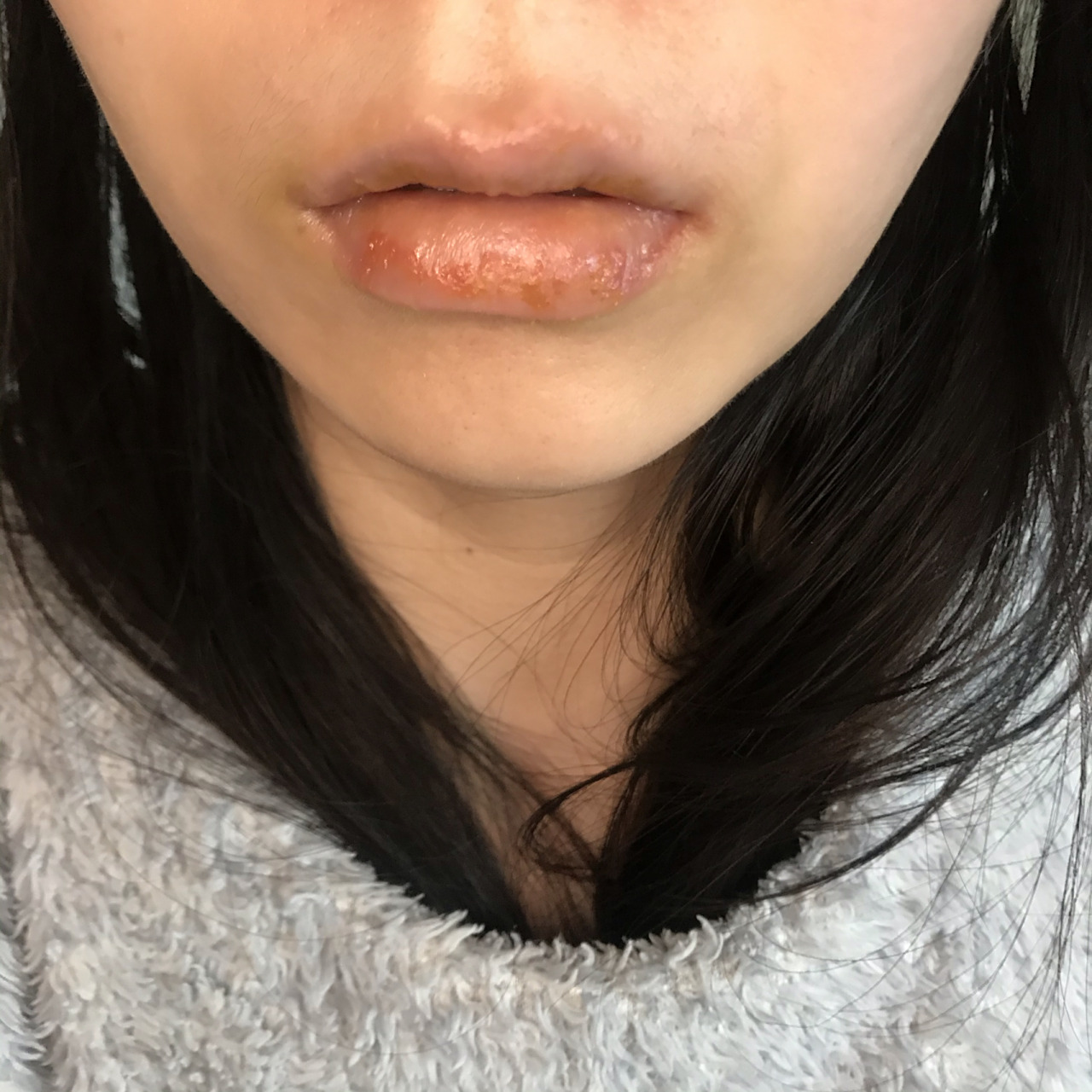 过敏性唇炎治好了 集美们!