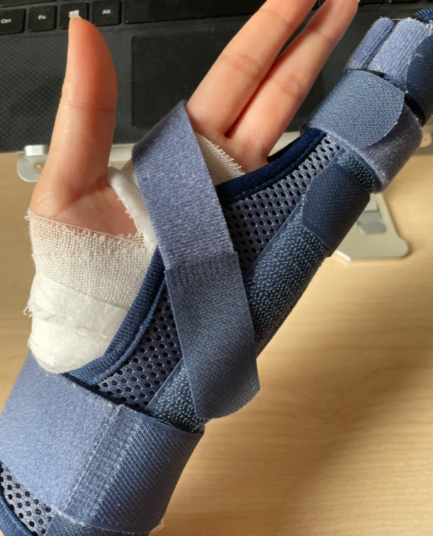 用夹板,支具或者石膏固定骨折部位,防止活动让