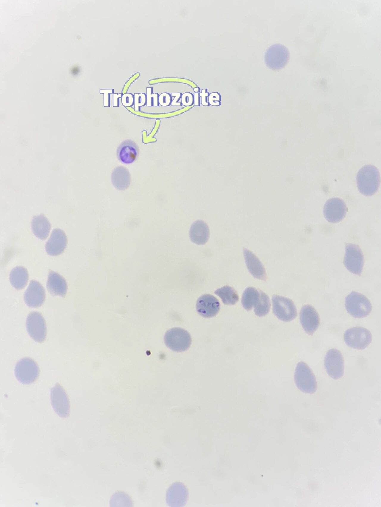 数一数恶性疟原虫| malaria疟疾 malaria 疟疾 图中是plasmodium