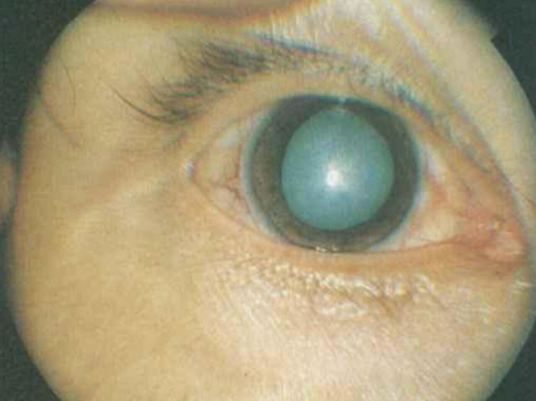 恶性青光眼～致盲危症 睫状环阻滞性青光眼又称恶性青光眼.