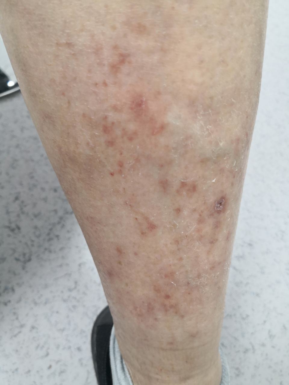 小腿湿疹症状,考虑下肢静脉曲张导致的淤积性皮炎#皮肤##解决皮肤问题