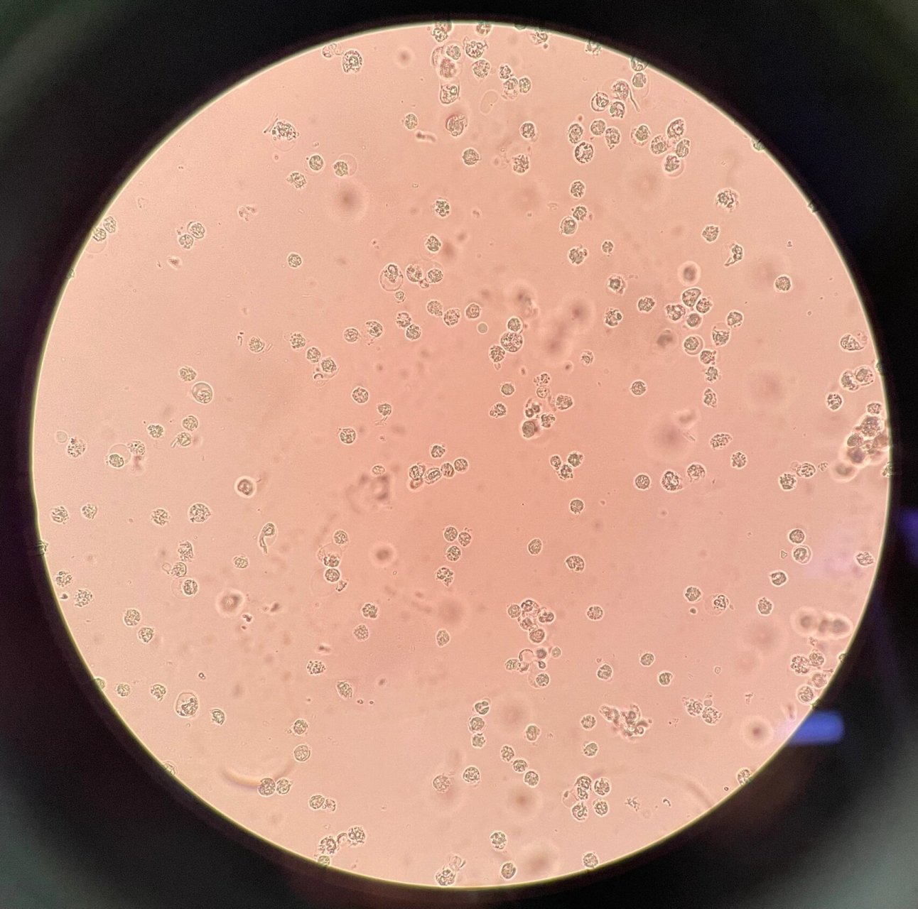 尿液镜检 上面四张图高倍镜下有大量白细胞及少量红细胞.