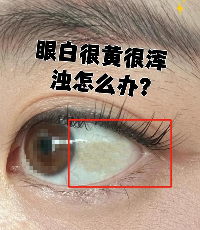 眼白很黄很浑浊可能由多种原因引起,需要根据具体原因处理