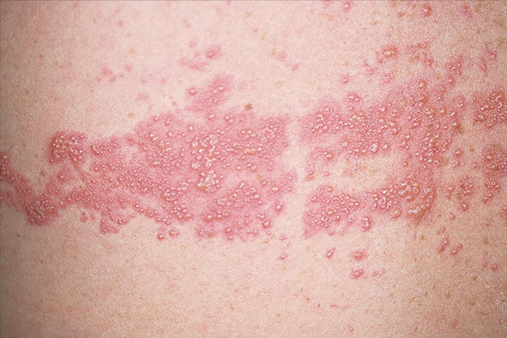 很多人在腰背部会出现一种密集的红斑,小水泡,就像蛇一样缠在腰上