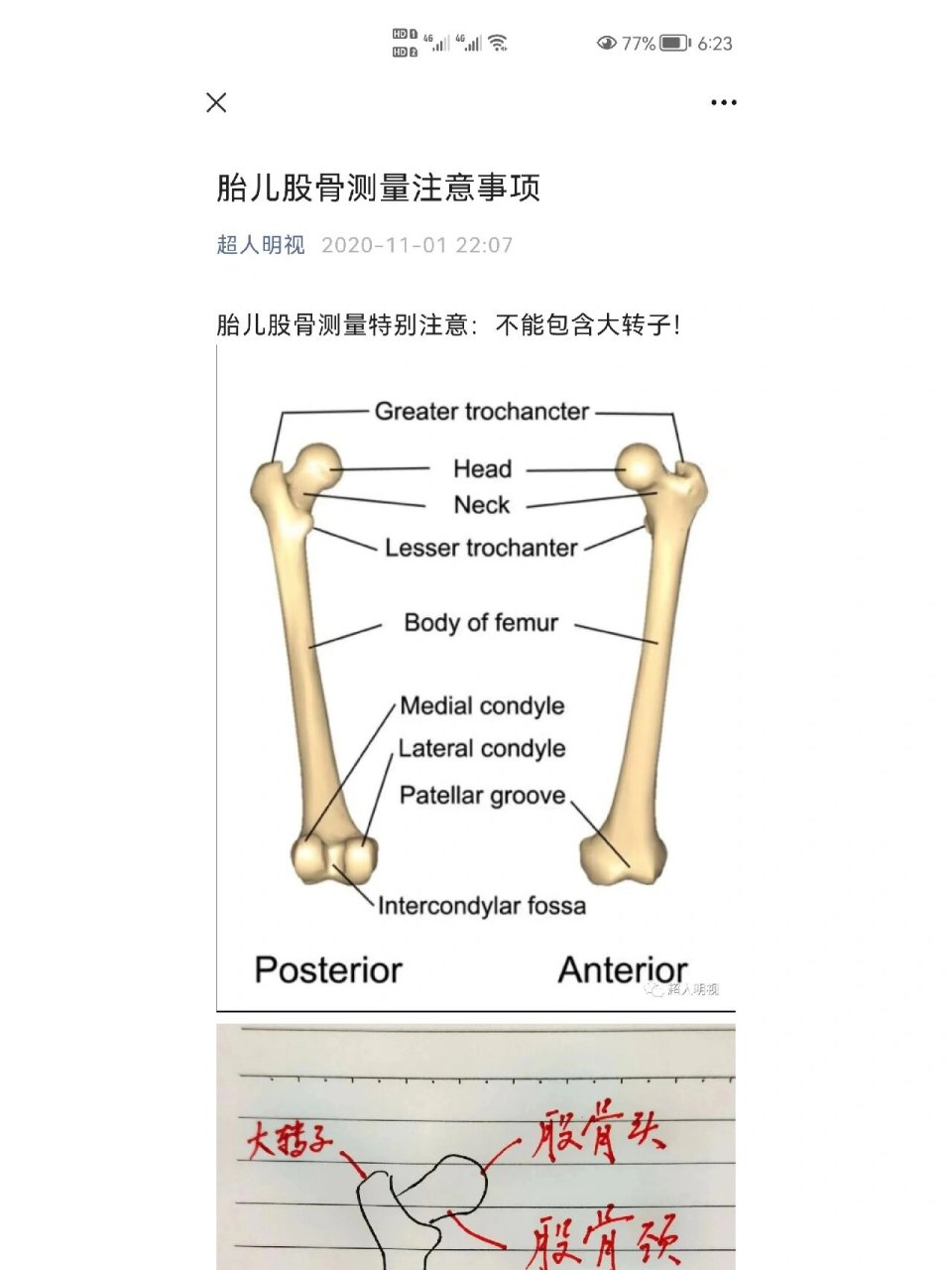 股骨短|股骨长测量误差很大?小心! 这是转载邓学东医生公众号.