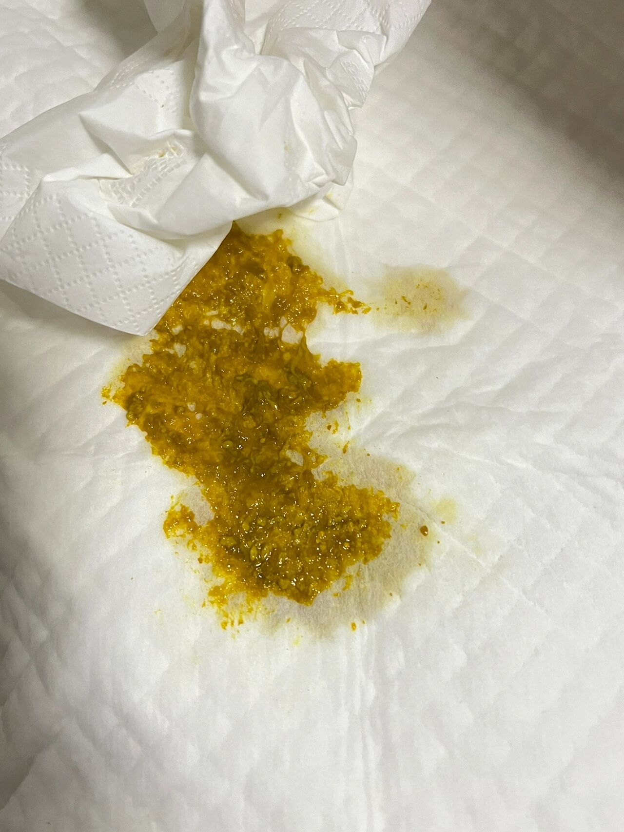 宝宝拉屎感觉很稀,而且有白色颗粒奶瓣.