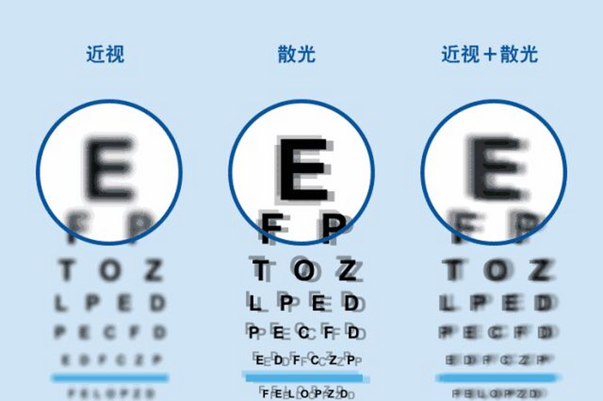 一张图了解近视和散光的区别